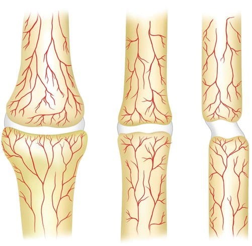 Expert Care for Nonunion Fractures