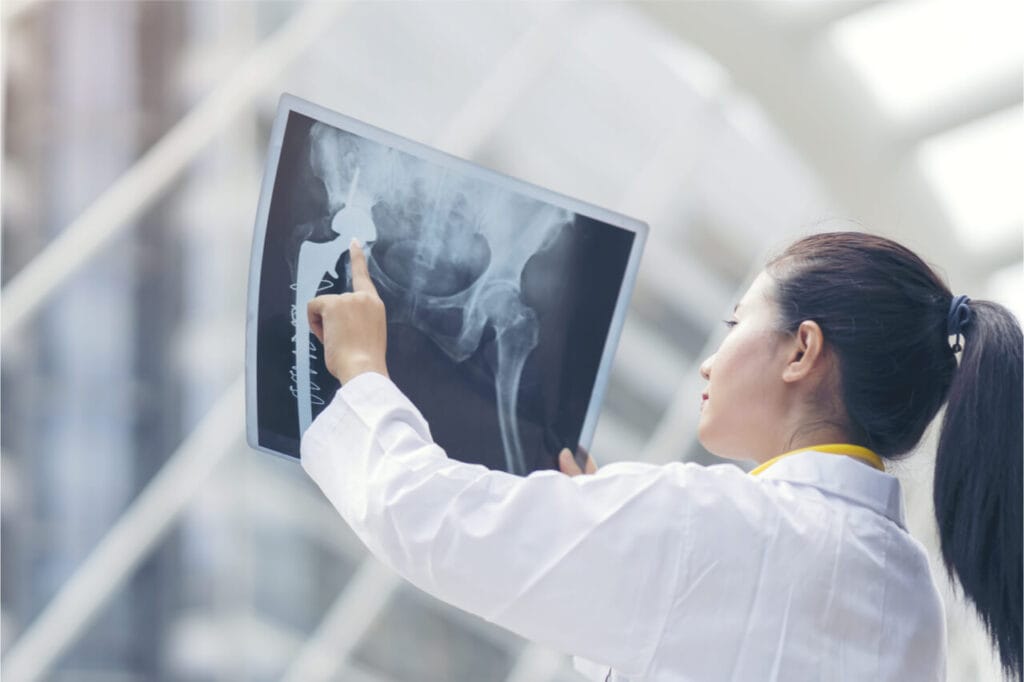 Expert Care for Nonunion Fractures