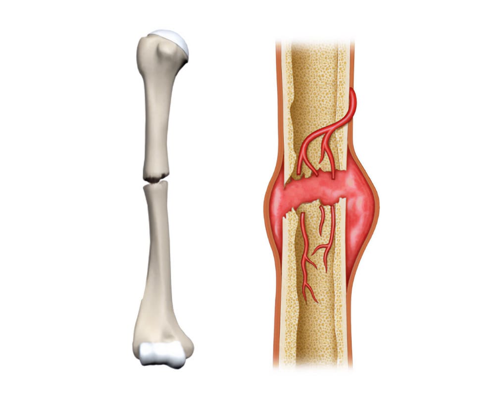 Expert Care for Nonunion Fractures